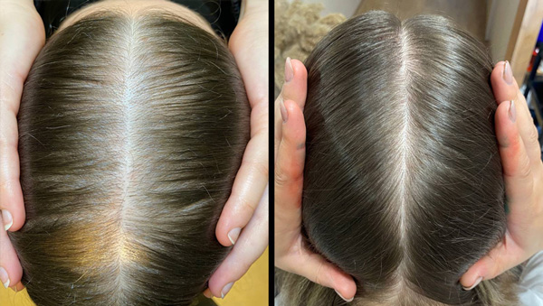 Orising до/после 6 мес